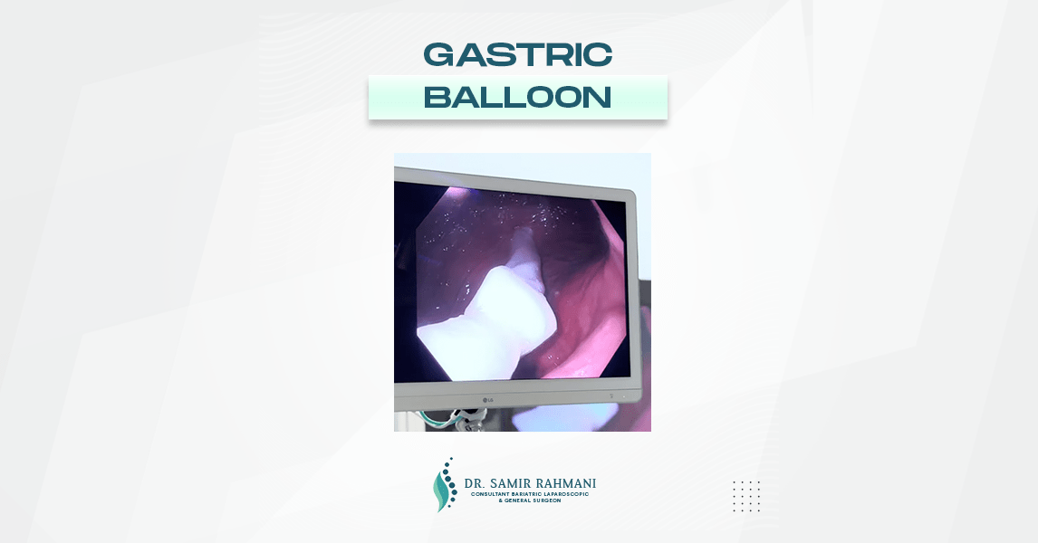 Dr.Samir Website Gastric Balloons Services Video Thumbnail