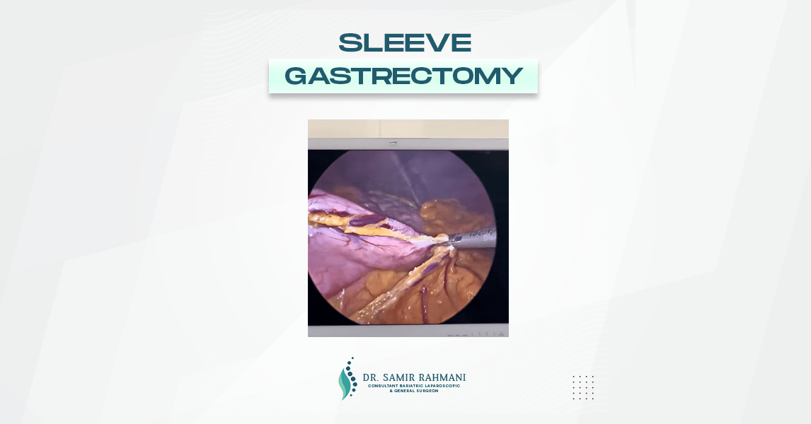 Dr.Samir Website Sleeve Gastrectomy Services Video Thumbnail