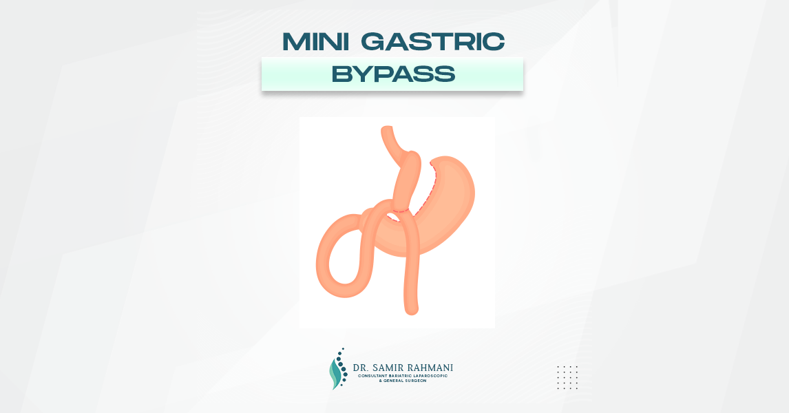 Dr.Samir Website Mini Gastric Bypass Services Video Thumbnail